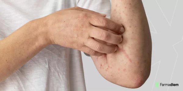 síntomas de piel atópica