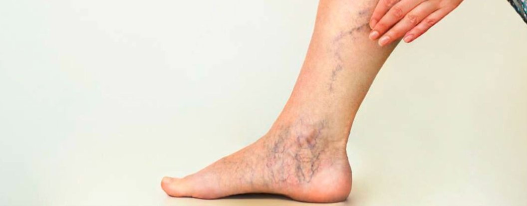 Insuficiencia venosa y varices