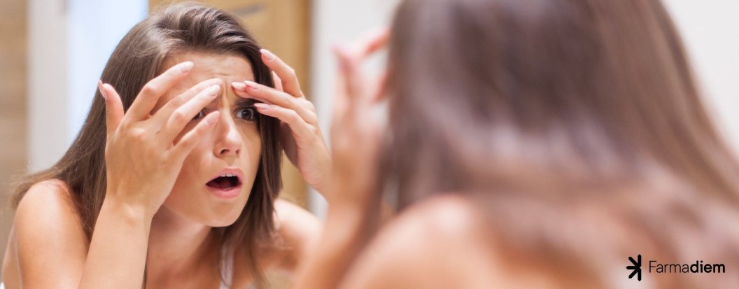 Acn&eacute;: S&iacute;ntomas y causas