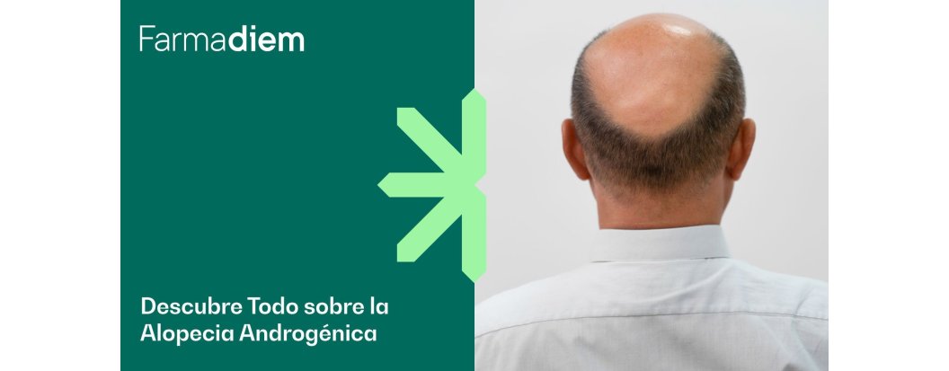 Alopecia androg&eacute;nica: Caracter&iacute;sticas y Tratamiento