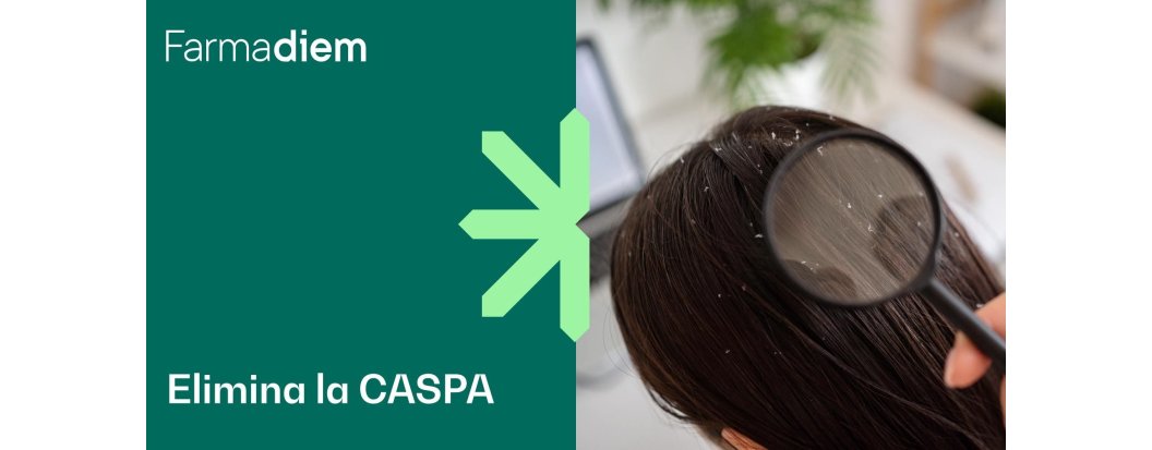 Cómo prevenir y tratar la caspa y el cuero cabelludo seco