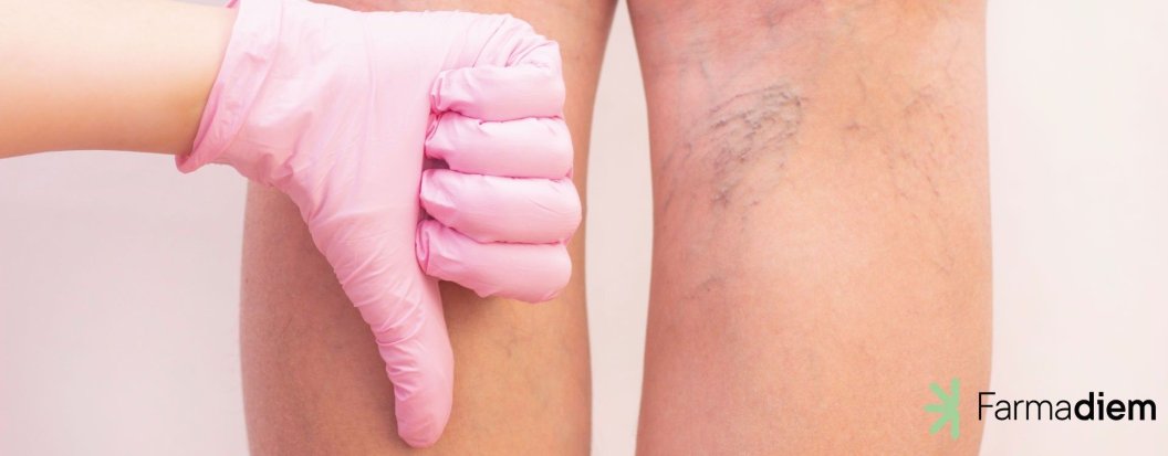 Mala circulación en las piernas