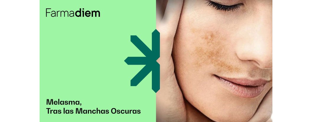 Melasma: La Afecci&oacute;n Cut&aacute;nea de las Manchas Oscuras