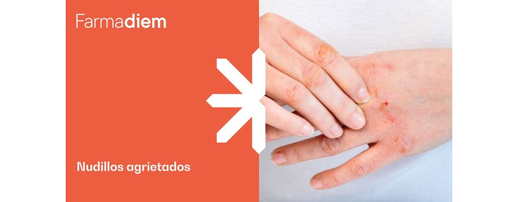 Nudillos agrietados: causas y remedios para tratarlos